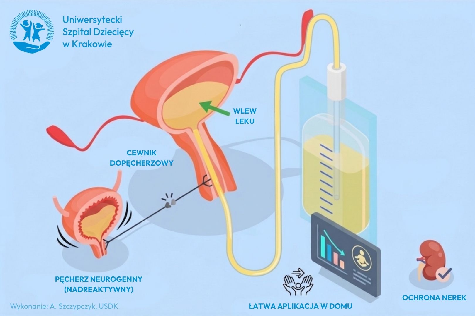 Infografika edukacyjna USDK w Krakowie. Przedstawia schemat układu moczowego: po lewej pęcherz neurogenny (nadreaktywny), po prawej proces leczenia – cewnik dopęcherzowy wprowadzający wlew leku z worka infuzyjnego. Grafika zawiera ikony symbolizujące łatwą aplikację w domu oraz ochronę nerek.
